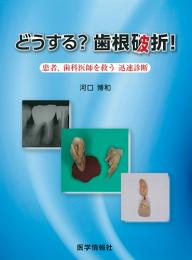 どうする? 歯根破折!　患者、歯科医師を救う 迅速診断